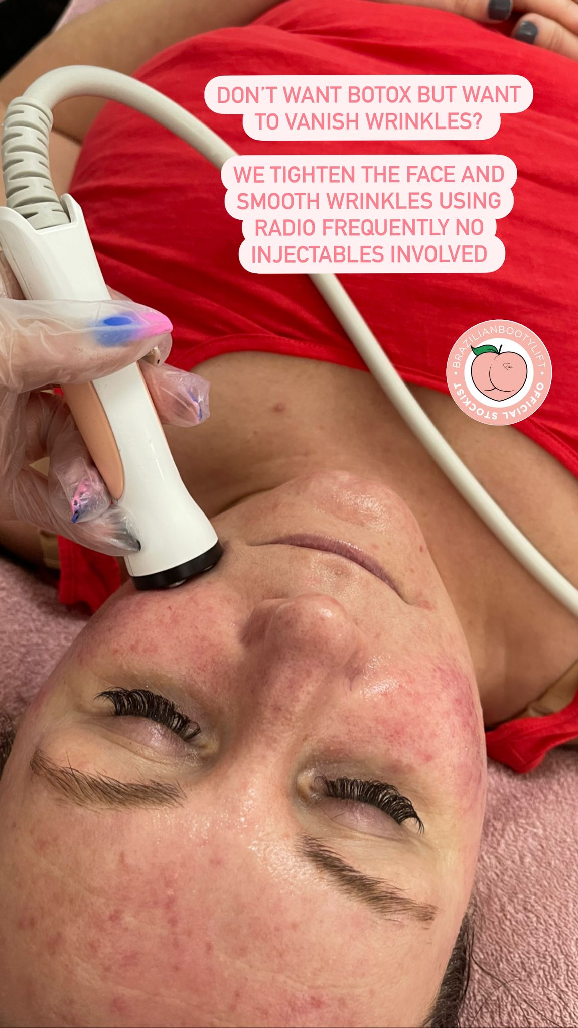How Does A BBL Non-Surgical Facial lift Work? – An Honest Review